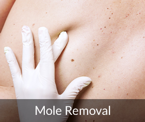 Scarless mole removal