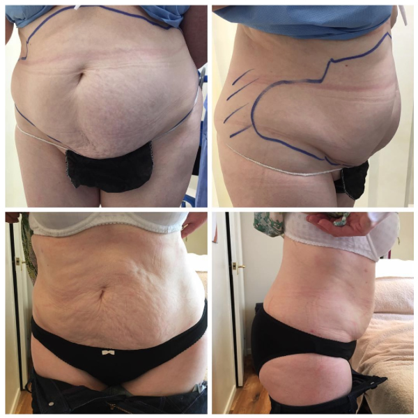 Fabulous result on patient with real difficulties who sought help at Stratford Dermatherapy Clinic. We performed BodyJet water assisted liposuction and after 4 months have allowed her to invest in new found confidence and new wardrobe!
