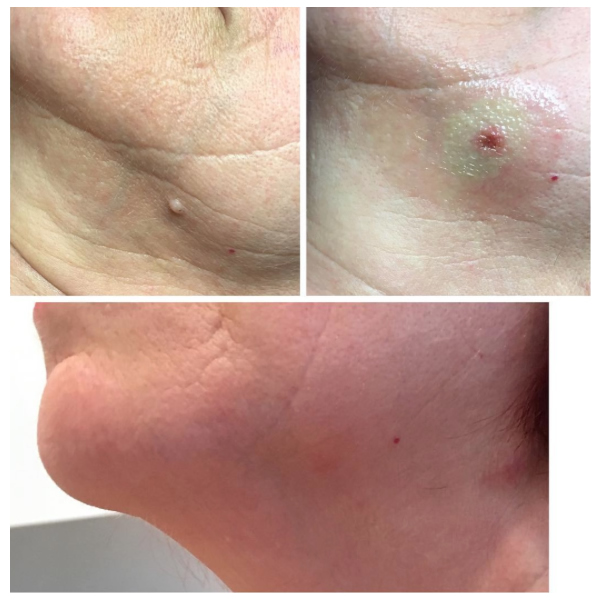 Before, immediately after and 4 weeks after RF Scarless surgical removal of mole.