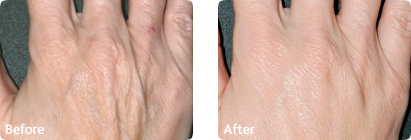 Fat transfer hands jpeg