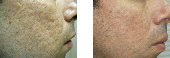 acne scarring treated with Airgent