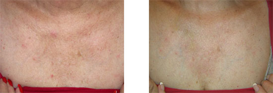 age spots treated with Airgent