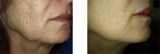 before and after airgent treatment on the chin