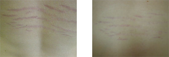 stretch marks treated with Airgent