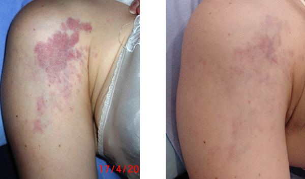Photoderm IPL before and after photo