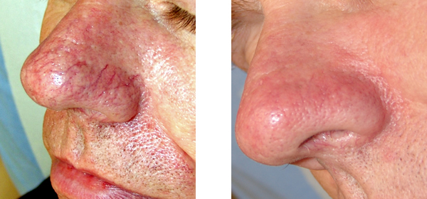 Photoderm IPL for Rosacea before and after photo