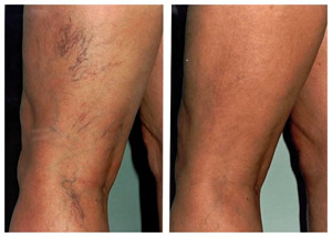 Before after treatment for leg veins
