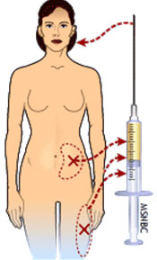 Fat transfer