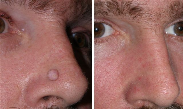 Warts and Wart Removal