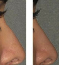 Before and after non surgical nose reshaping.