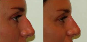 Before and after nose reshaping using dermal fillers.