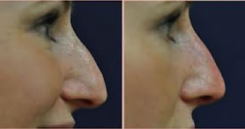 Before after non surgical nose-job Warwickshire