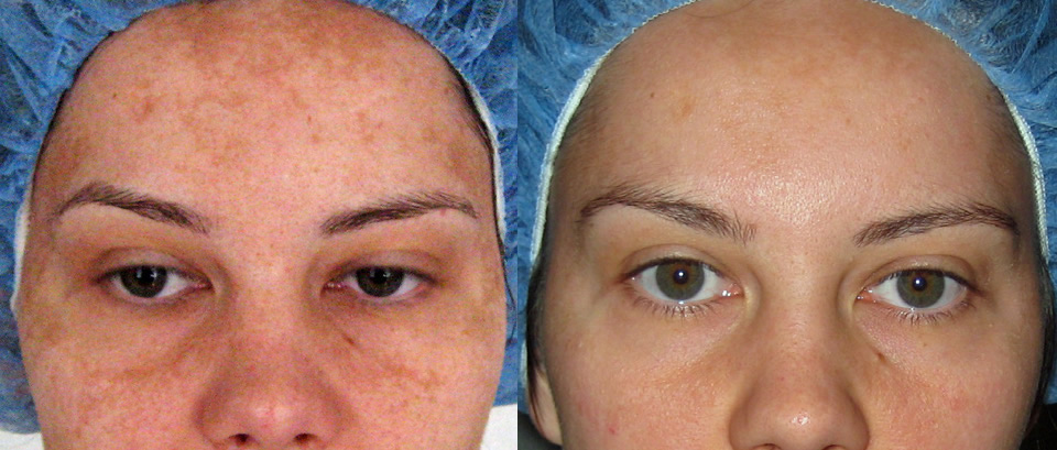Co je to Melasma?