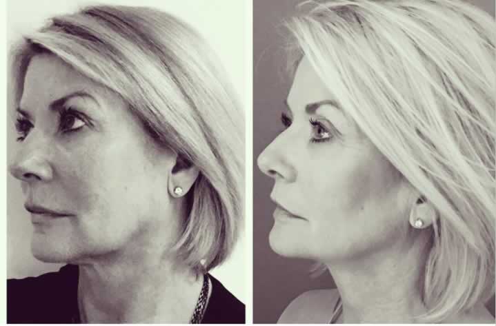 When the wife's happy with what you do, it makes it more real when recommending it to your patients! Before and 8 weeks post PDO HoneyDerma Thread lift...pure jawline.