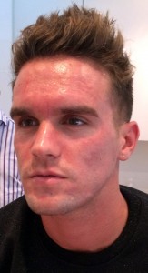 Mild painless redness only immediately post treatment.