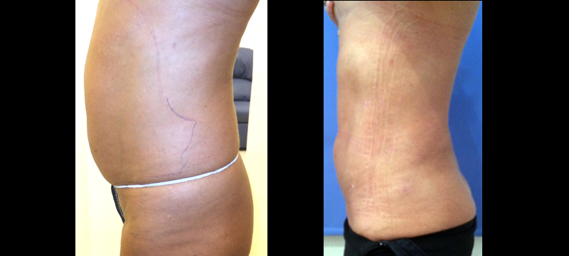 Before and 2 weeks after Body Jet treatment to the abdomen.
