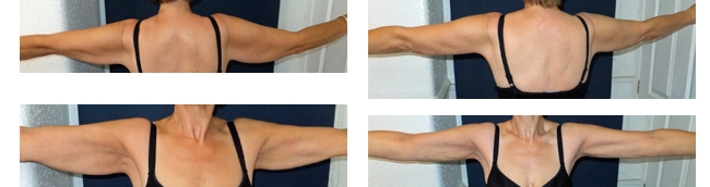 Before and after Vaser Lipo