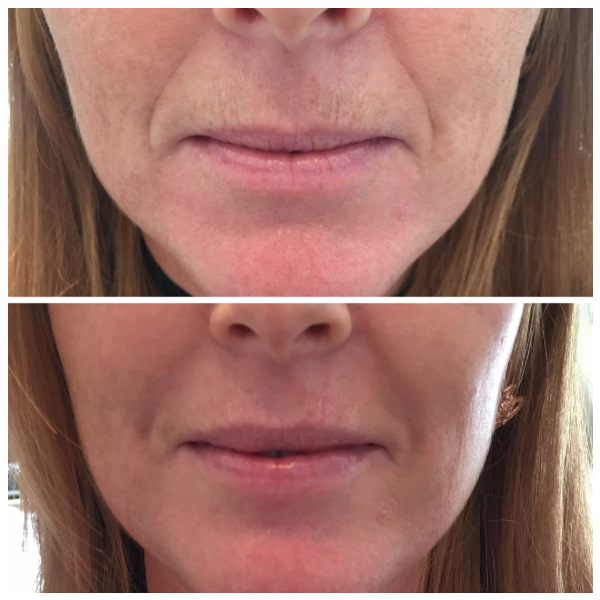 Before and after a combination of Resylane Kysse and Skinboostersvitallight 