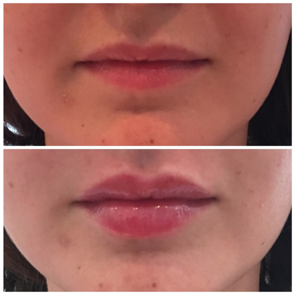 Before and after Emerval Lips ... and then you enhance a 25 year old with beautiful lip projection.