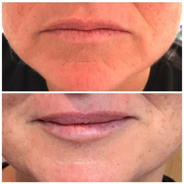Aged 43. Beautiful subtle augmentation. Before and after Restylane Kysse.