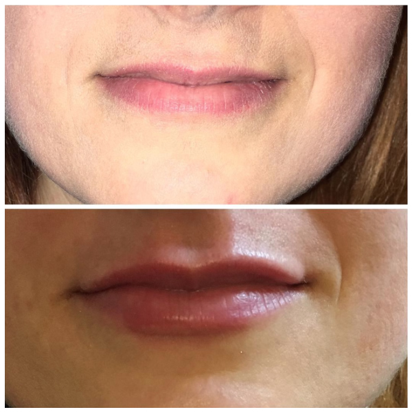 Before and after Emerval Lip, a beautiful proportionate enhancement of vermillion border.