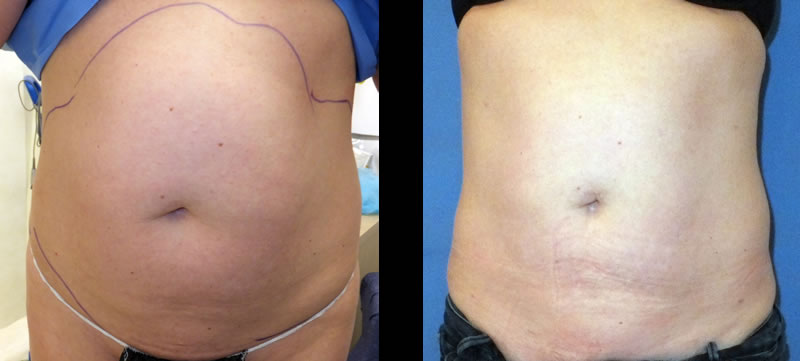 Before and 3 months after Body Jet treatment to the abdomen