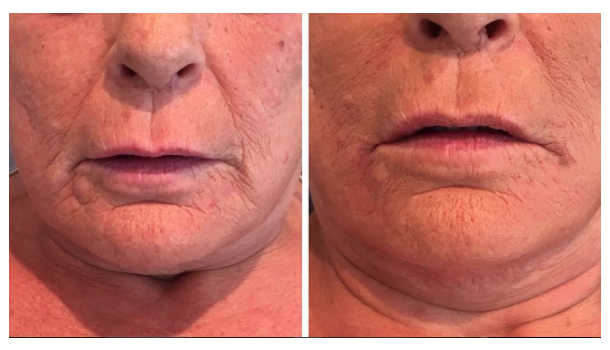 Heavy smoker, UV damage treated with Emervel Lips and Restylane Skinboosters Vital Light. Massive change immediately after treatment.