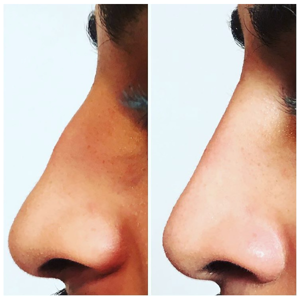 Before and after a Non-surgical "nose job" using dermal fillers