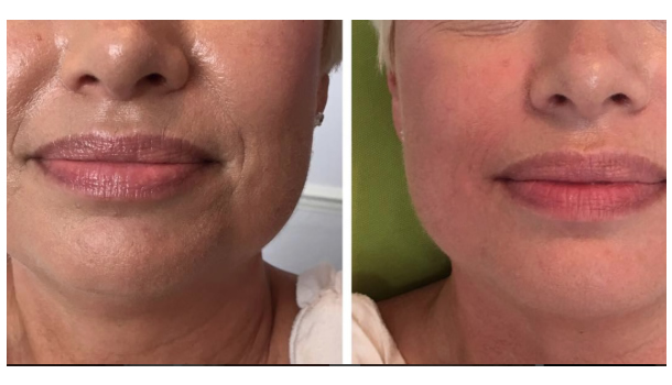 Pre and post Restylane Skinbooster vital light.