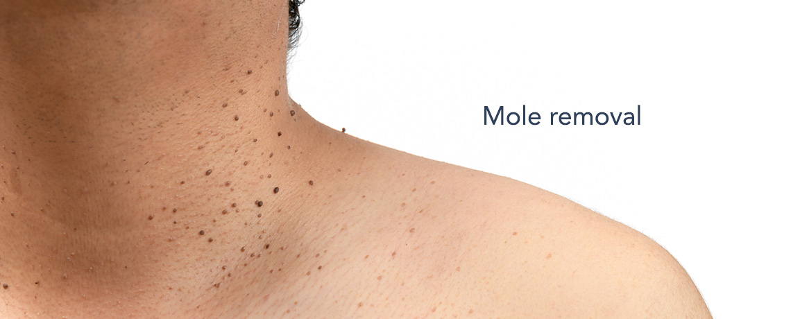 Mole and skin tag removal Warwickshire