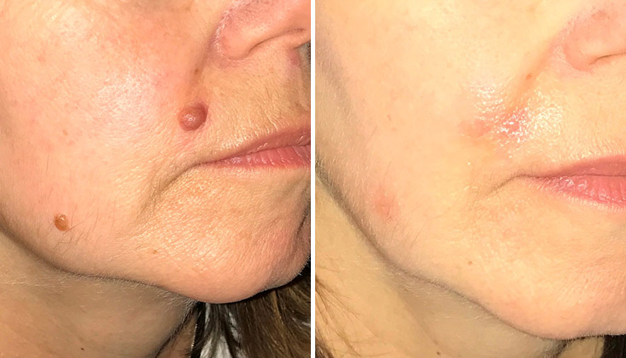 Before and after mole removal with radio frequency in Stratford