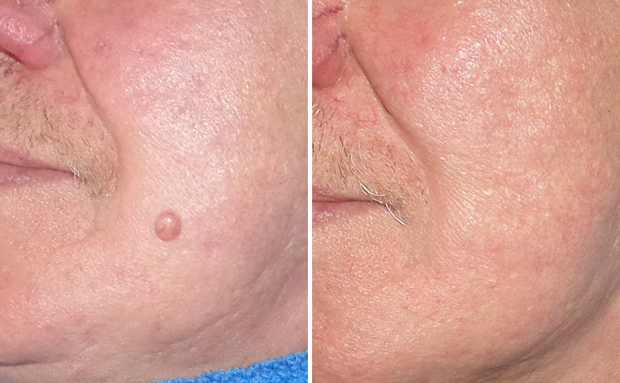 Before and after mole removal with radio frequency in Stratford